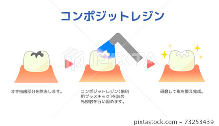 複合樹脂CR膠修復方法圖解 73253439