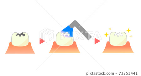 Illustration of composite resin CR adhesive restoration method 73253441