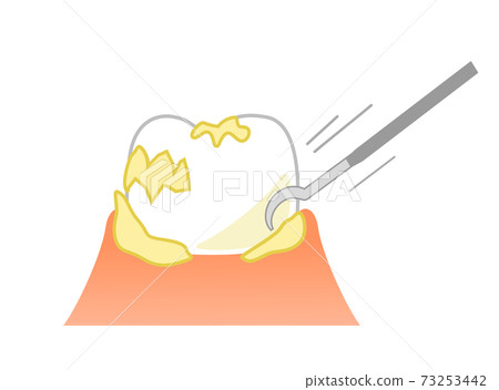 Periodontal Plaque Removal and Scaler: Dental Illustration 73253442