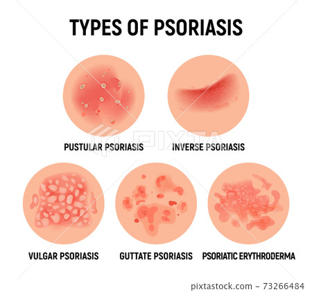 Psoriasis rash vector skin hand infection background. Psoriasis dermatitis eczema cartoon 73266484