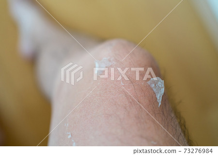 Peeling after sunburn Peeling after sunburn 73276984