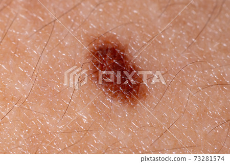 Spot on the skin Spot on the skin 73281574