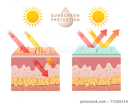 Uv skin protection. Damaged human skin peels before and after sun protection body adipose layers epidermis recent vector infographic template 73308154
