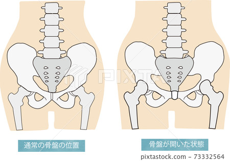 Illustration of a normal pelvis and an illustration showing the open state of the pelvis Illustration of a normal pelvis and an illustration showing the open state of the pelvis 73332564