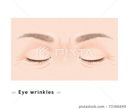 兩隻眼睛的皺紋細皺紋眉毛女性臉閉眼皮眼科案例衰老真實插圖 兩隻眼睛的皺紋細皺紋眉毛女性臉閉眼皮眼科案例衰老真實插圖 73366849