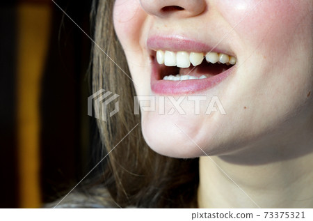 Lack of lateral incisors. Teeth before placing 73375321