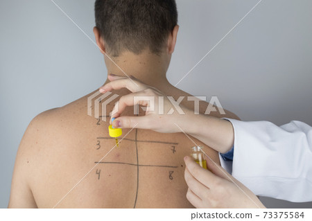 An allergist in the laboratory conducts an allergy prick-test. Skin test for household, food, epidermal allergic reactions. The test is performed on the patient back 73375584