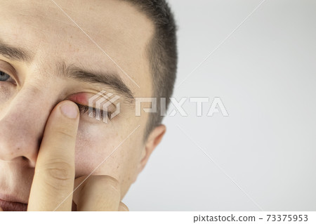 A man stands in front of a mirror and sees inflammation of the upper eyelid. Redness of the skin around the eyes and blepharitis. 73375953