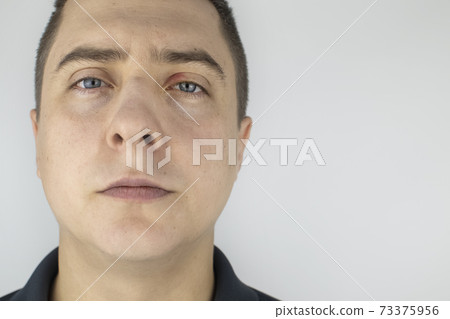 A man stands in front of a mirror and sees inflammation of the upper eyelid. Redness of the skin around the eyes and blepharitis. A man stands in front of a mirror and sees inflammation of the upper eyelid. Redness of the skin around the eyes and blepharitis. 73375956