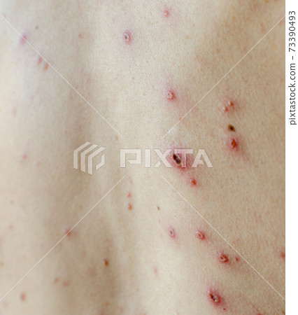 Large spots and pimples acne on the body - adult body with chickenpox. man with Chickenpox, Varicella, Varicella Zoster Virus. Large spots and pimples acne on the body - adult body with chickenpox. man with Chickenpox, Varicella, Varicella Zoster Virus. 73390493