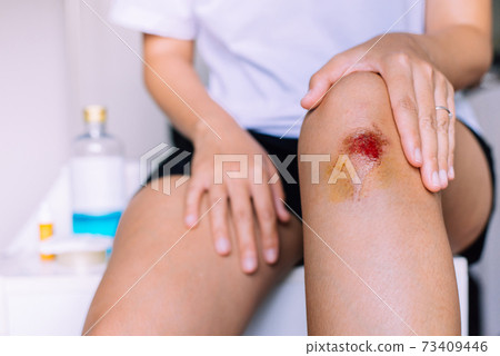 Woman using alcohol into a cotton for cleaning bleeding wound on knee,Scab becomes Infected 73409446