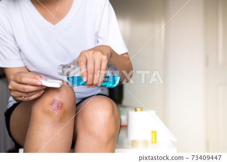 Woman pouring alcohol into a cotton for cleaning bleeding wound on knee,Scab becomes Infected 73409447