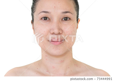 laser treatment 73444991