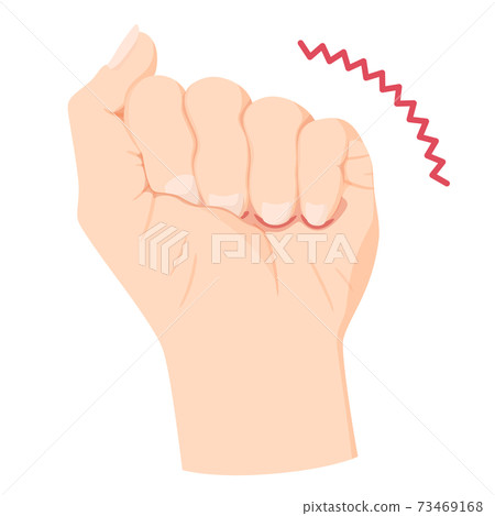 Illustration of hand contracture 73469168