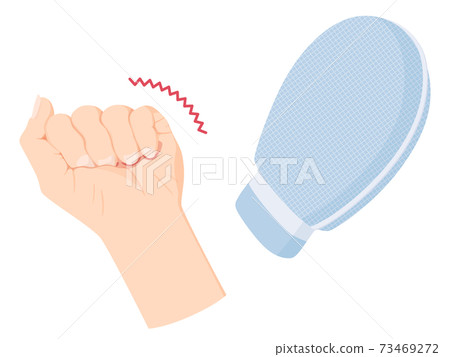 Illustration of mittens and hand contracture_physical restraint Illustration of mittens and hand contracture_physical restraint 73469272