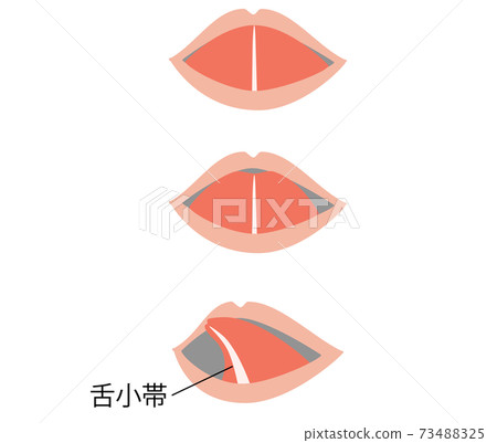 Illustration that becomes a heart shape when the tongue is stretched due to ankyloglossia 73488325