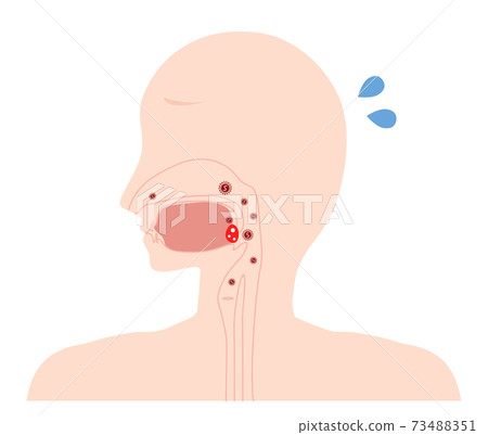 Tonsillitis inflammation illustration Tonsillitis inflammation illustration 73488351