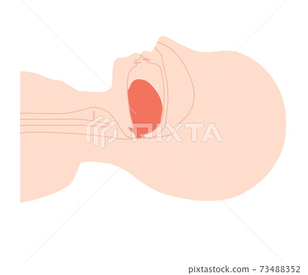 Sleep apnea syndrome illustration with the tongue down 73488352