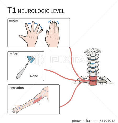 T1 nerve reflex medical illustration 73495048