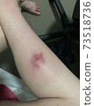 我在國外被昆蟲咬了 73518736