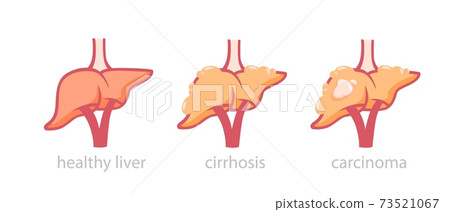 Healthy liver and tumor damaged illustration. Process transformation normal organ into fatty hepatosis and cirrhosis. Healthy liver and tumor damaged illustration. Process transformation normal organ into fatty hepatosis and cirrhosis. 73521067