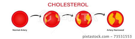 Stages cholesterol formation in erythrocytes clipart. Filling red blood cells with yellow thrombus. Stages cholesterol formation in erythrocytes clipart. Filling red blood cells with yellow thrombus. 73531553