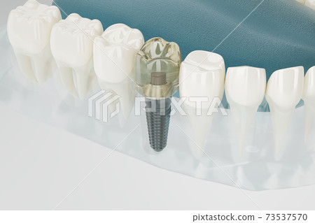 Dental implants transparent. 3D rendering. 73537570