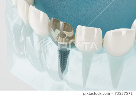 Component of Dental implants transparent. 3D rendering. 73537571