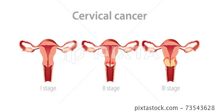 Cervical cancer stages illustration. Development gynegological tumor in female vagina with subsequent growth of oncology. 73543628