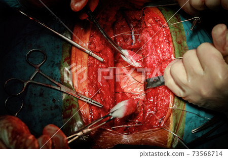 Surgeons suturing on sick patient after performing a serious surgery. 73568714