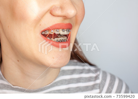 Braces in the smiling mouth of a girl. Smooth teeth from braces. 73599420