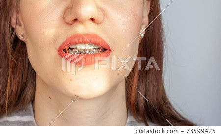 Braces in the smiling mouth of a girl. Smooth teeth from braces. 73599425