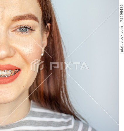 Braces in the smiling mouth of a girl. Smooth teeth from braces. Braces in the smiling mouth of a girl. Smooth teeth from braces. 73599426