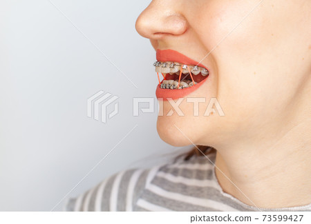 Braces in the smiling mouth of a girl. Smooth teeth from braces. 73599427