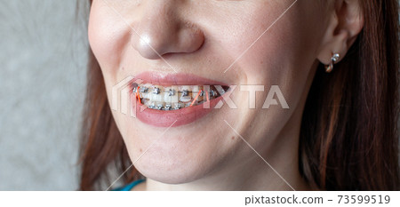 Braces on the teeth of a girl who smiles, close-up lips,  73599519
