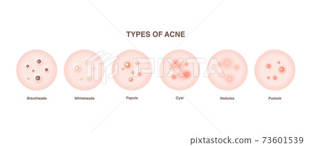 Acne types set 73601539