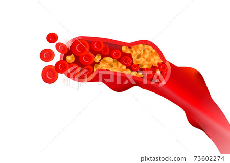 Not healthy arteries with red erythrocytes, high cholesterol concept illustration on white Not healthy arteries with red erythrocytes, high cholesterol concept illustration on white 73602274