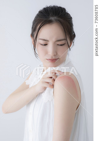 Sunburn image (special make-up) Sunburn image (special make-up) 73608785