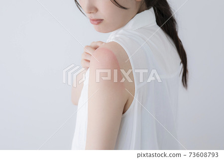 Sunburn image (special make-up) Sunburn image (special make-up) 73608793