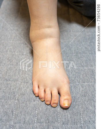 Swollen female legs Swollen female legs 73654298