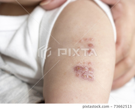 卡介苗注射的嬰兒手臂（0歲，6個月大，女孩，日本人） 73662513