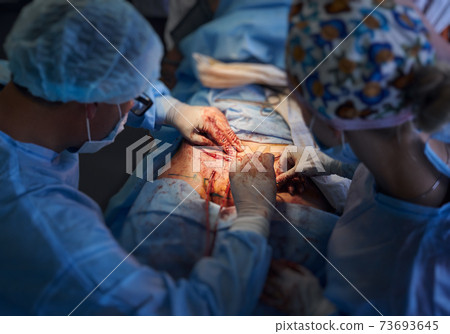 Surgical team performing abdominoplasty surgery in operating room. 73693645