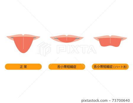 由於舌頭小帶縮短而使舌頭拉伸時變成心形的插圖 73700640
