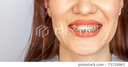 Braces in the smiling mouth of a girl. Smooth teeth from braces. 73726961