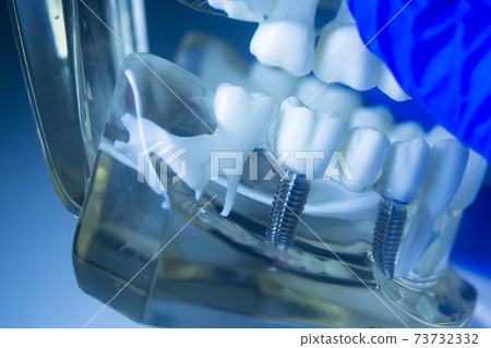 Dental tooth implant 73732332