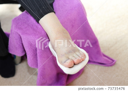 腳趾骨折損傷 腳趾骨折損傷 73735476
