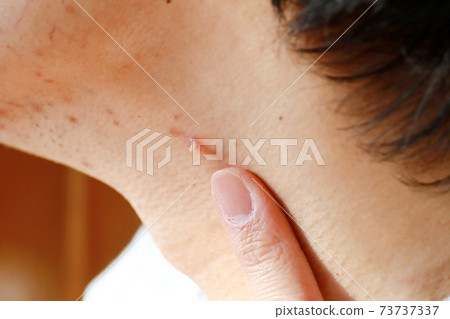 尋常型，絲狀疣，病毒性疣 73737337