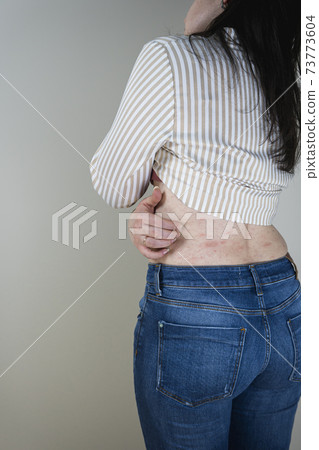 Women with symptoms of itchy urticaria or allergic reaction on the skin. Red rash on the females body. 73773604
