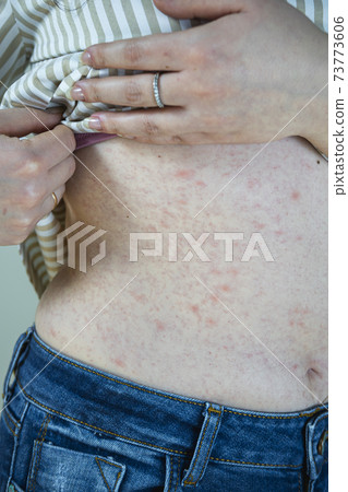 Women with symptoms of itchy urticaria or allergic reaction on the skin. Red rash on the females body. 73773606