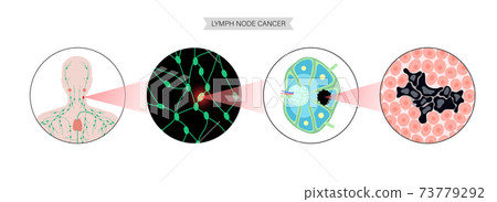 Lymphoma cancer concept Lymphoma cancer concept 73779292